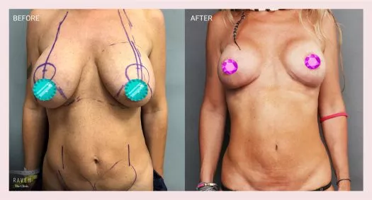 MOMMY MAKEOVER: הרמת שדיים החלפת שתלים מ 375 סמ"ק דו"צ ל 245 סמ"ק דו"צ פרופיל בינוני של מוטיבה. שאיבת שומן ומיצוק הבטן לפני ואחרי