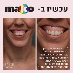 גאמי סמייל: החיוך החדש שלי