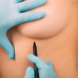 האם ניתוח הגדלת חזה מתאים לי?