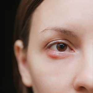 מהן הסיבות שבגללן נשים עוברות הרמת עפעפיים?