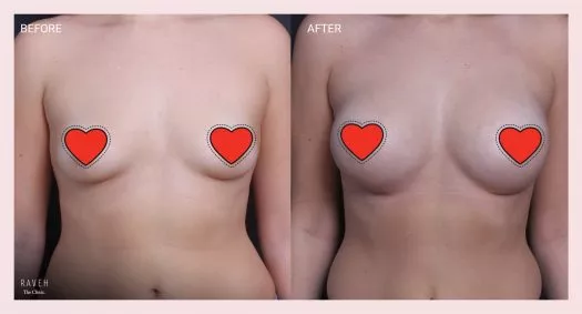 ניתוח הגדלת חזה עם שתל