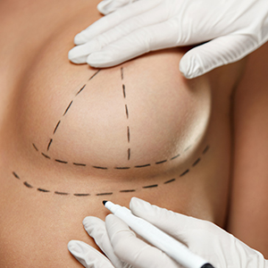 הרמת חזה עם שתלים – כללים לשמירה על שביעות רצון גבוהה לאורך זמן