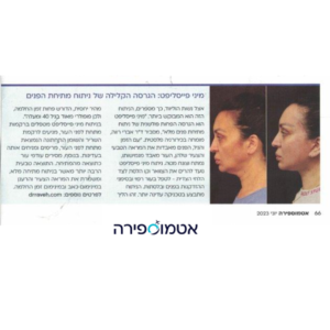 מיני פייסליפט: הגרסה הקלילה של ניתוח מתחית הפנים